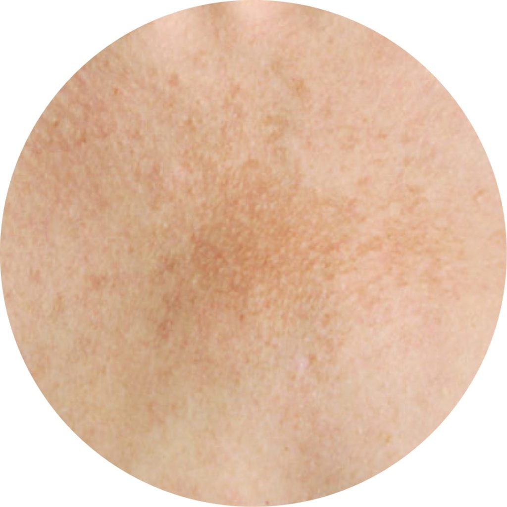 Skin hyperpigmentation | ISDIN